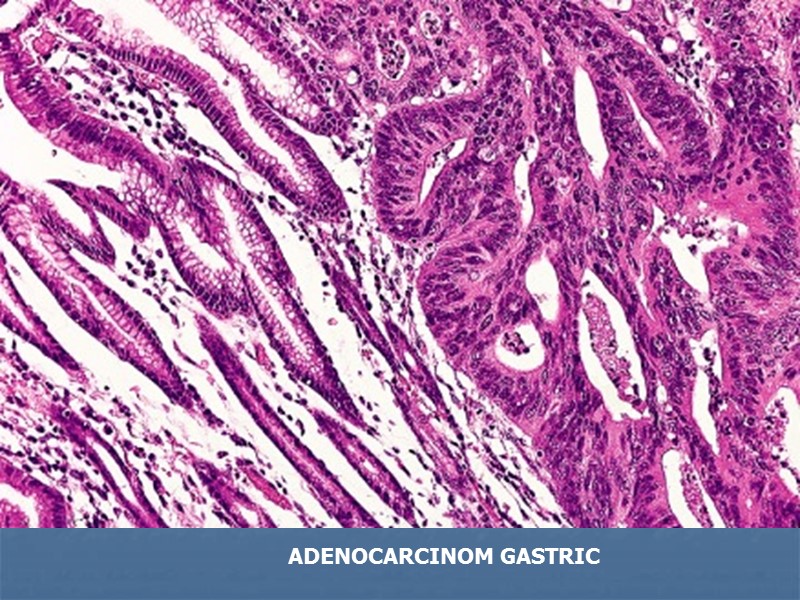 ADENOCARCINOM GASTRIC